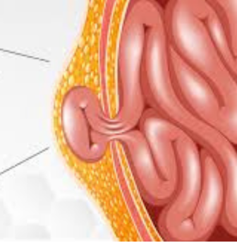 Hernia