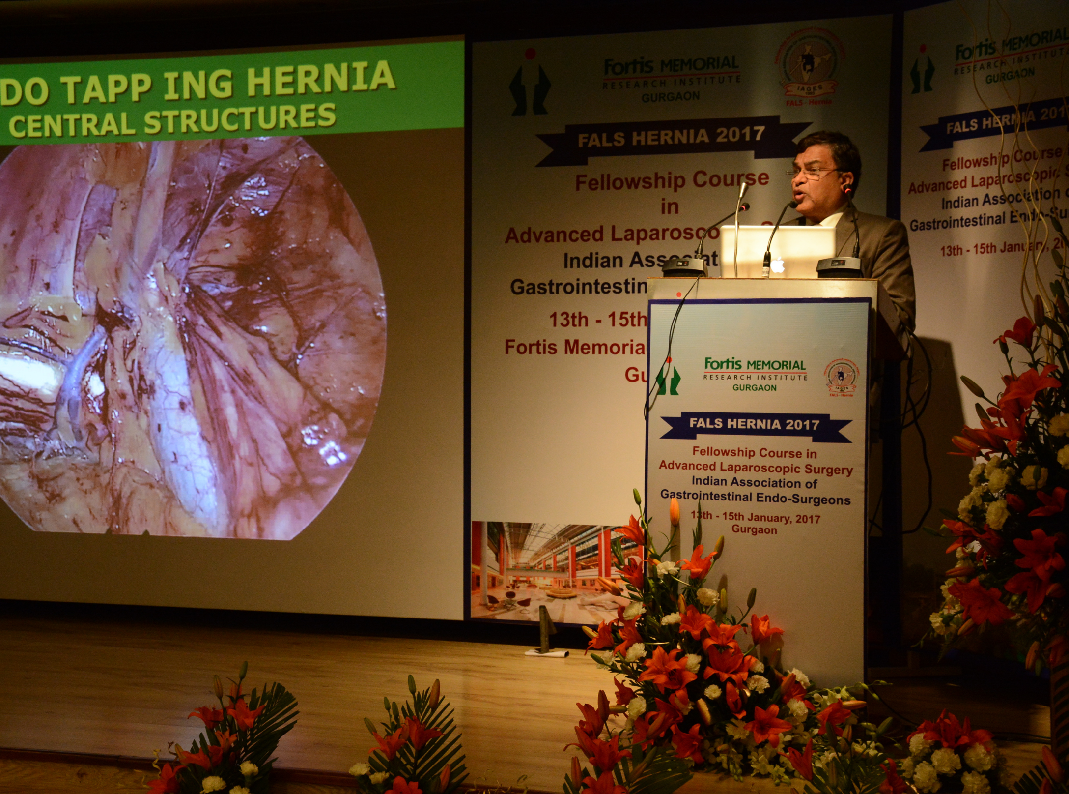 Explaining hernia