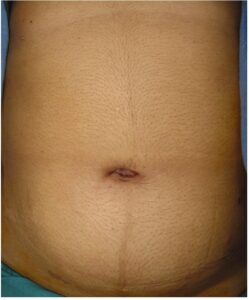 Sils - After surgery