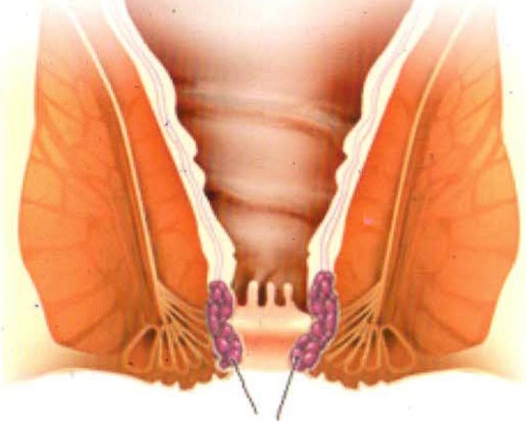 Internal Hemorrhoids