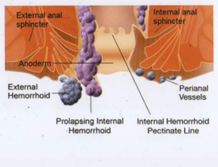 Thrombosed External Hemorrhoids
