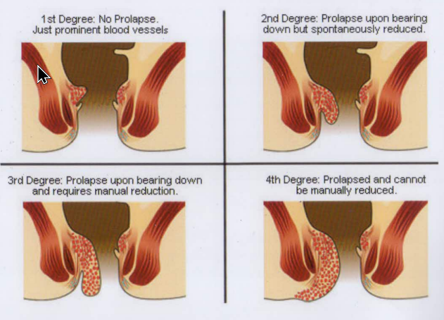 Grades of Hemorrhoids