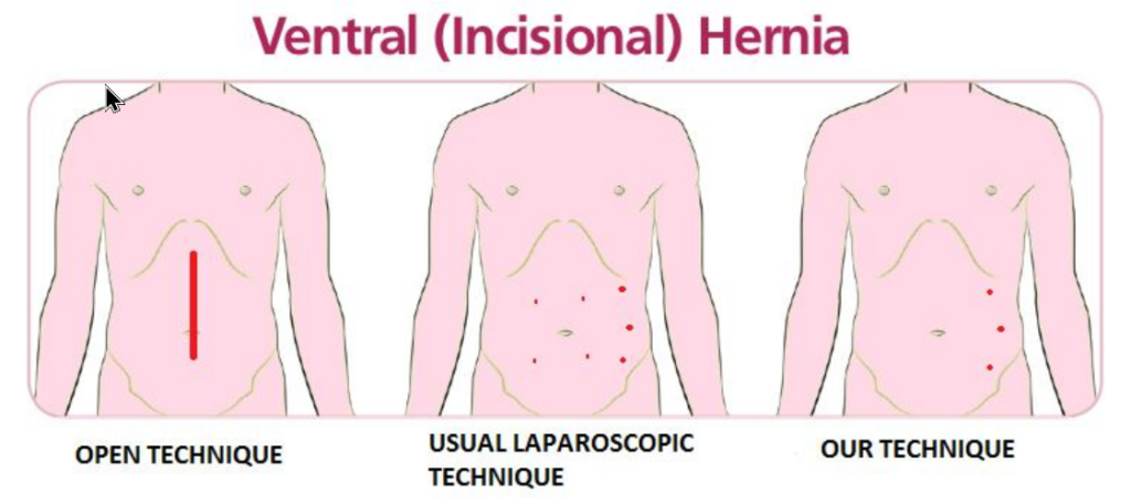Ventral Hernia
