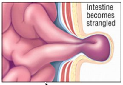 The intestine may become trapped