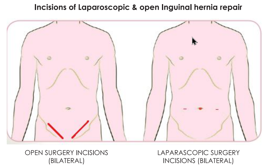 LAPAROSCOPIC REPAIR AND OPEN REPAIR