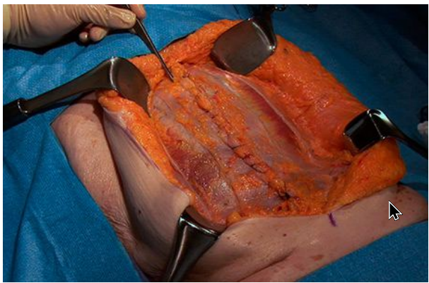 Medical Staff Performing Ventral Hernia