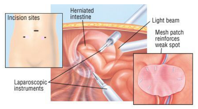 How Inguinal Hernia Performed
