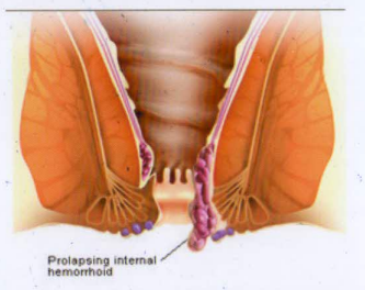 Prolapsed Internal Hemorrhoids