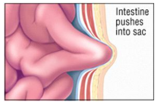 The intestine pushes into the sac
