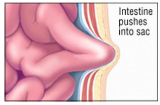 The intestine pushes into the sac further