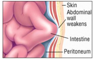 The wall weakens or tears