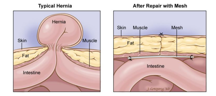 Typical Hernia