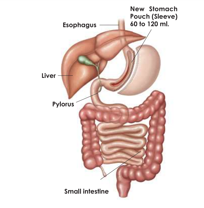 Sleeve Gastrectomy