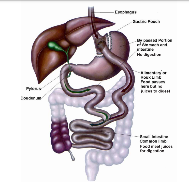 ROUX-EN-Y GASTRIC BYPASS