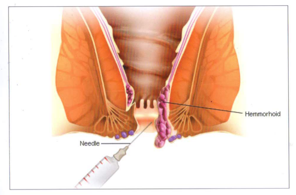Treatment: Grade 1 and Grade 2