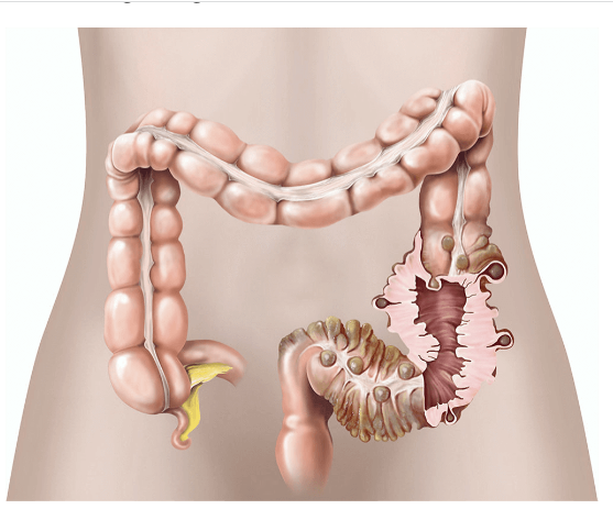 DIVERTICULITIS OF SIGMOID 370