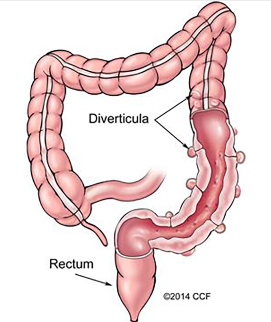 DIVERTICULOSIS 371