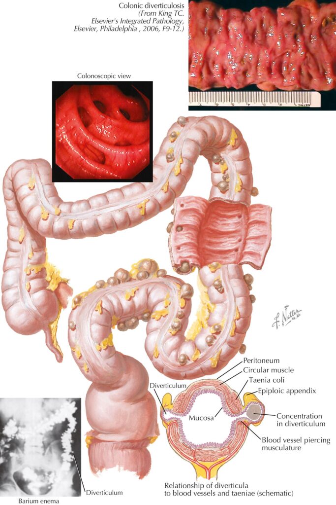 DIVERTICULOSIS NTLR