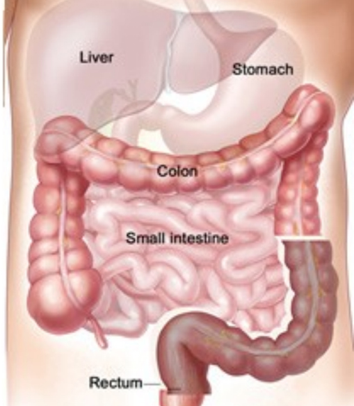 SIGMOID Colectomy