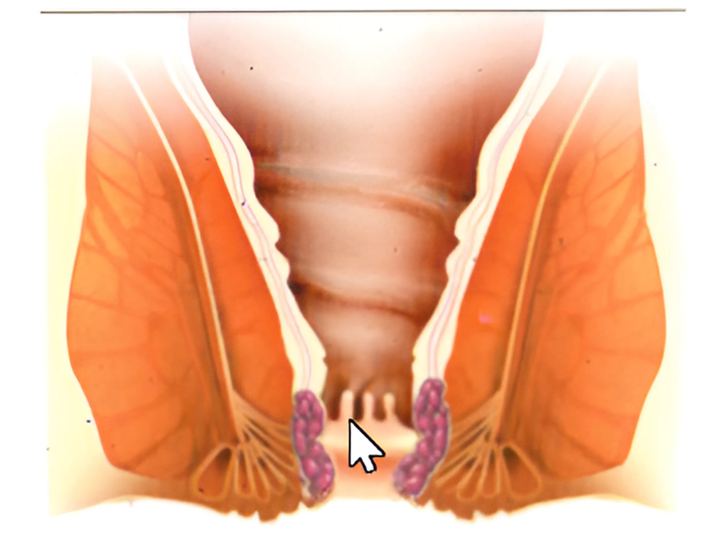 hemorrhoids