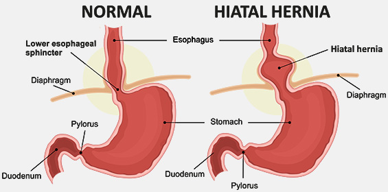 Hiatus hernia