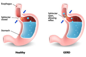 reflux