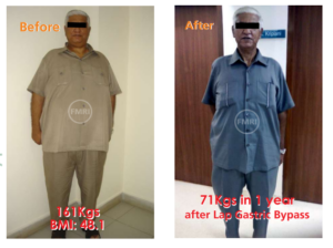 gastric bypass surgery patient of dr ajay kumar kriplani.