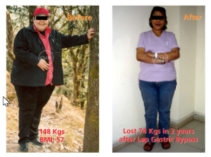 Female patient of gastric bypass surgery done by dr kriplani.