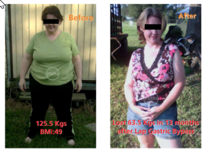 Happy patient of gastric bypass surgery done by dr ajay kumar kriplani.
