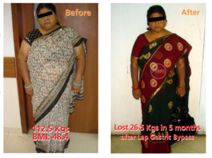 patient of gastric bypass surgery done by dr ak kriplani.
