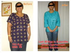 Successfull sleeve gastrectomy surgery of dr ajay kumar kriplani