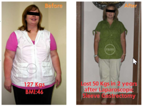 Successfull sleeve gastrectomy surgery of dr ajay kumar kriplani