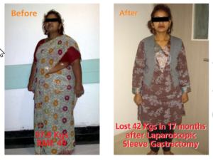 Successfull sleeve gastrectomy surgery of dr ajay kumar kriplani