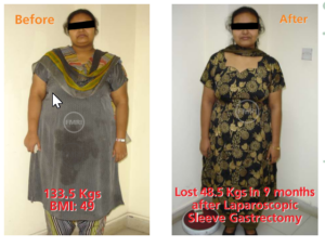 Successfull sleeve gastrectomy surgery of dr ajay kumar kriplani